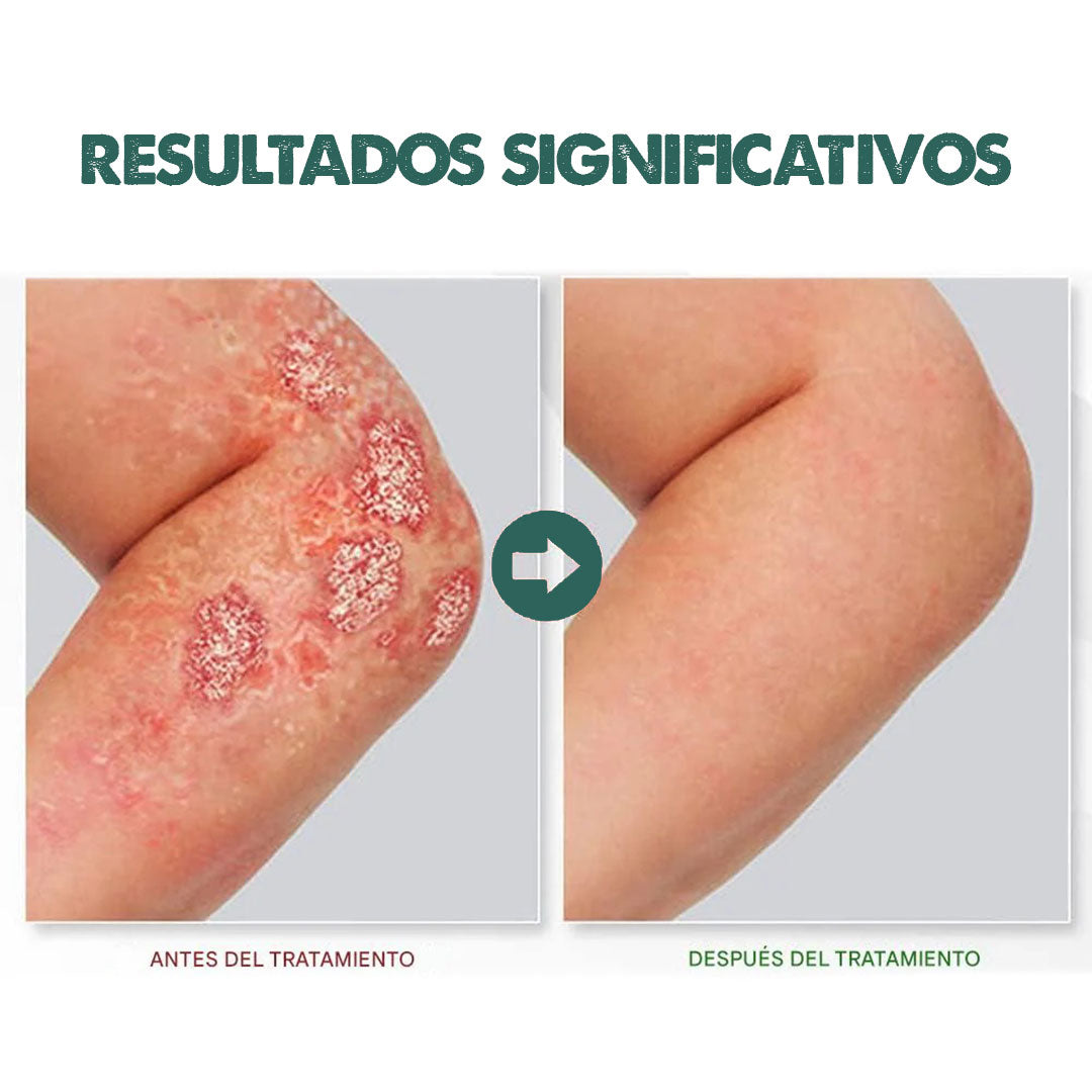 Eczema & Psoriasis Cream X2 UNIDADES | Dile adiós a la irritación y molestias
