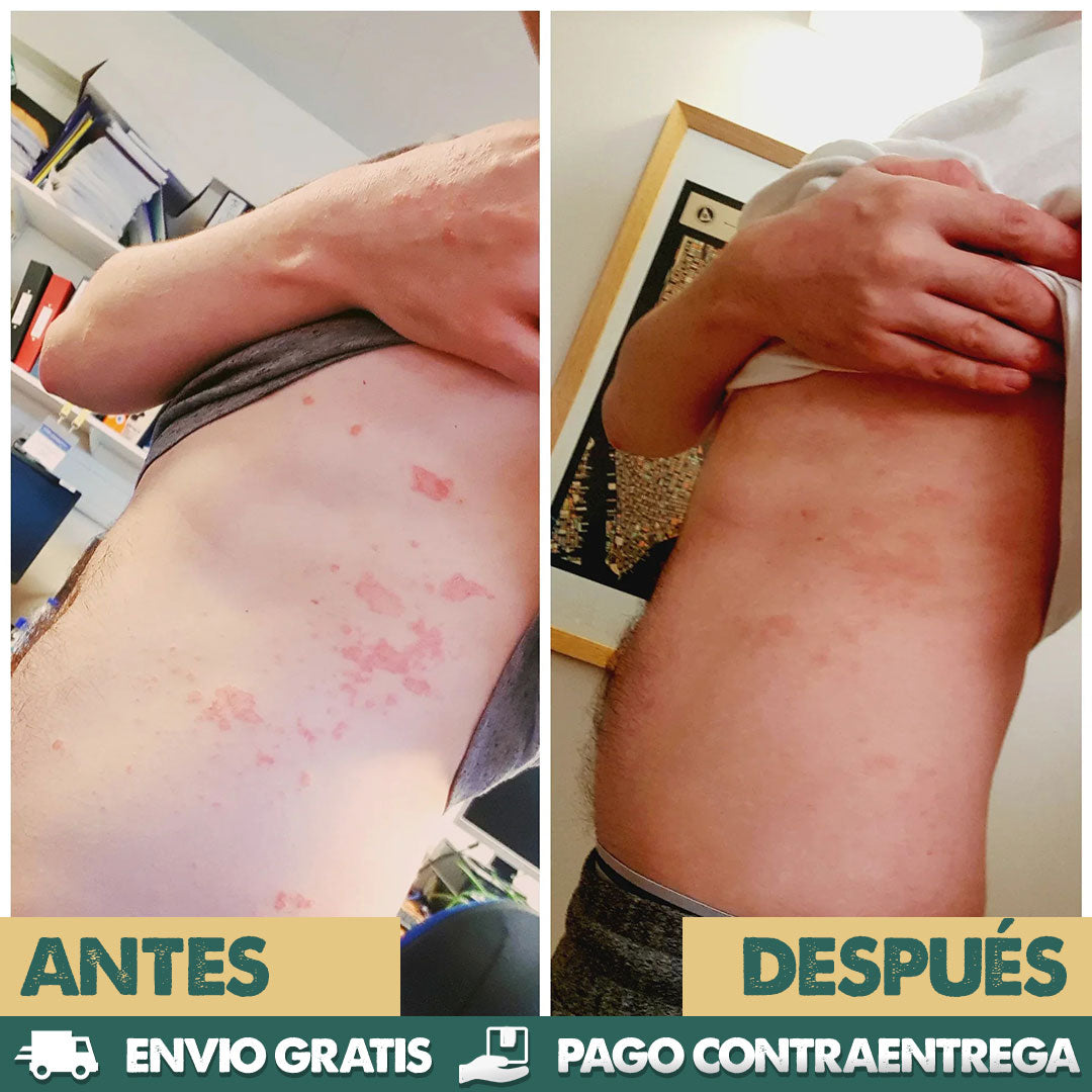 Eczema & Psoriasis Cream X2 UNIDADES | Dile adiós a la irritación y molestias
