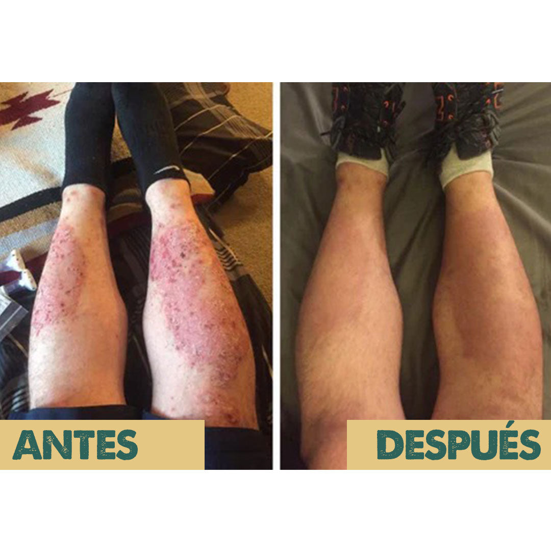 Eczema & Psoriasis Cream X2 UNIDADES | Dile adiós a la irritación y molestias