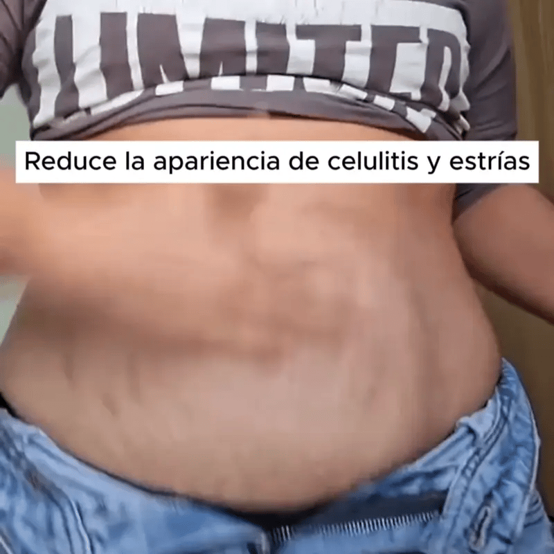 ADEUS - Adios a la celulitis y piel flácida