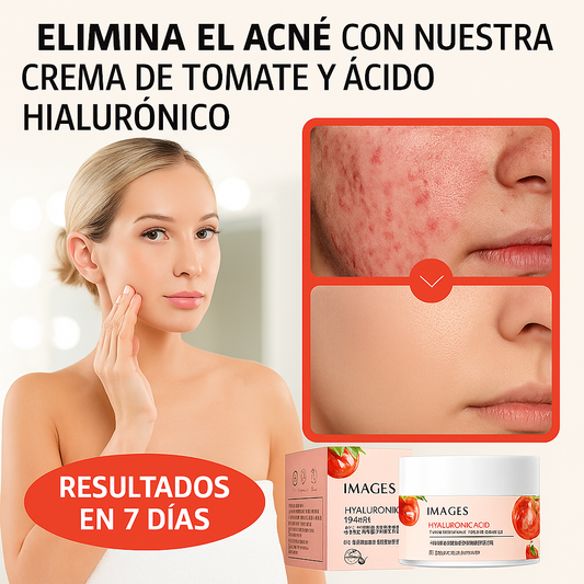 CREMA ANTI ACNÉ X1 UNIDAD