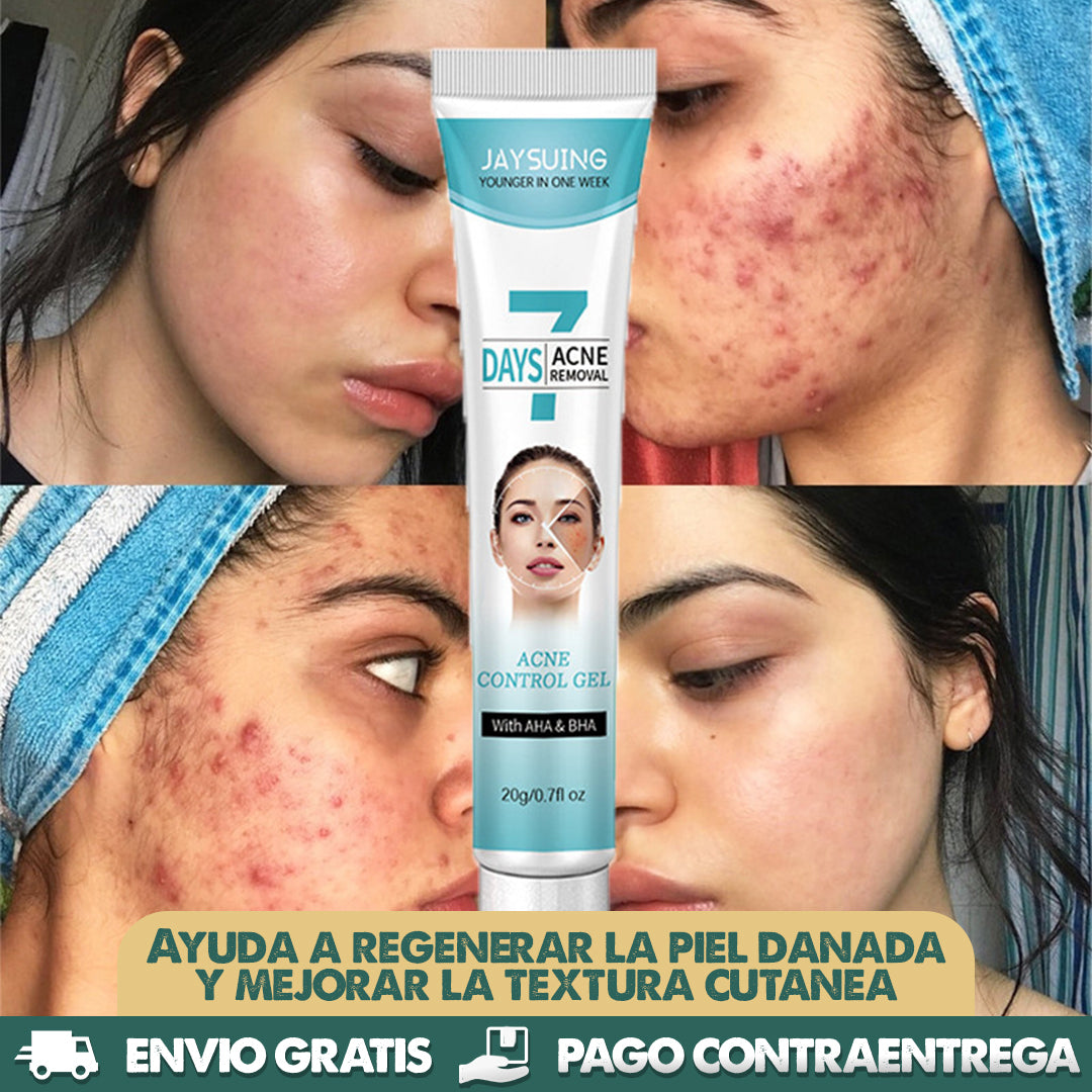 7 Days Acne Removal - Obten una Piel Sana y Lisa