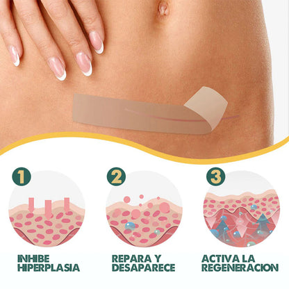 Silicone Marks Sheet | Elimina marcas en la piel en semanas