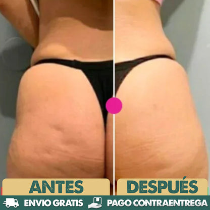 ADEUS - Adios a la celulitis y piel flácida