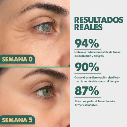 SilicSkin Pro | Suavizante de líneas de expresión